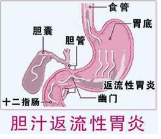 2:胆汁酸:胆汁酸是十二指肠反流液造成黏膜损伤的主要成分,对黏膜屏障