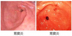 福州看胃窦炎要去哪个医院