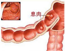 福州那家医院看肠息肉很好