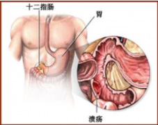 福州十二指肠溃疡要怎么治